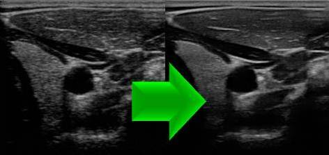 Технология подавления спекл-шума (iClear, SRI, XRES, DMR)
