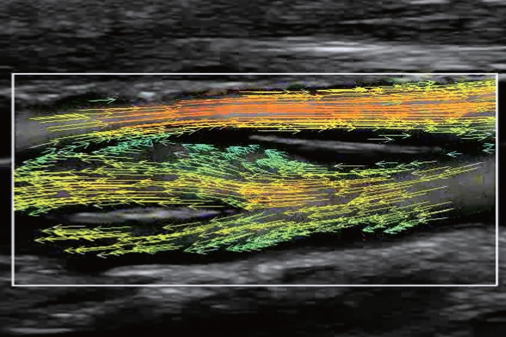 V Flow (Vector Flow) – новейшая технология визуализация кровотока, реализованная на платформе ZST+