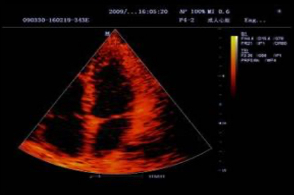 Режим тканевого допплера и количественный анализ